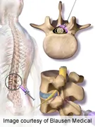 epidural-steroid-injection.jpg